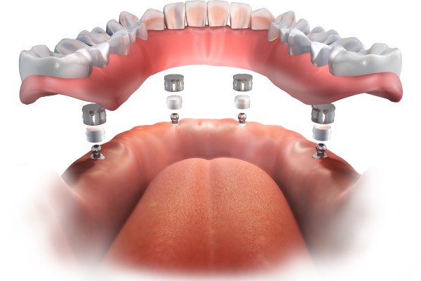 All On 4 Dental Implants Gladstone, MO