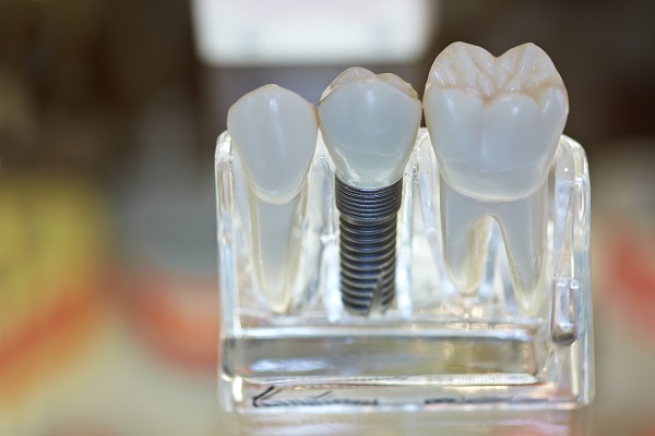 All On  ®: Can I Replace Multiple Missing Teeth?