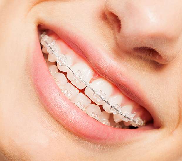 Gladstone Clear Braces