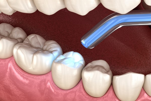 Why Is A Dental Filling Considered A Direct Dental Restoration?