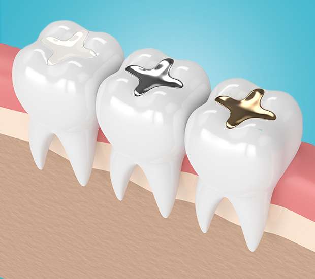 Gladstone Composite Fillings