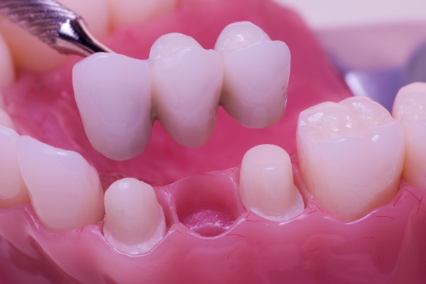 When Would A Dentist Recommend Dental Bridges?