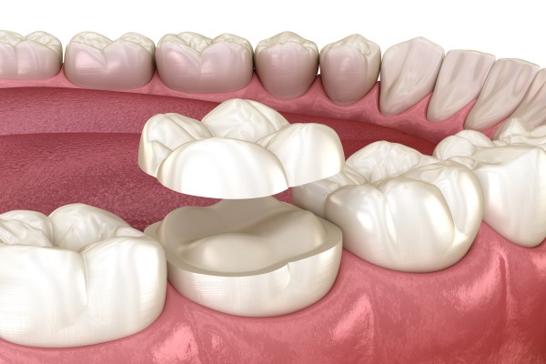 The Number Of Dental Visits For A Dental Crown