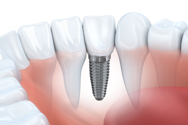 Dental Implants Gladstone, MO