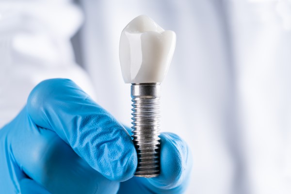 Signs You May Need Dental Implants