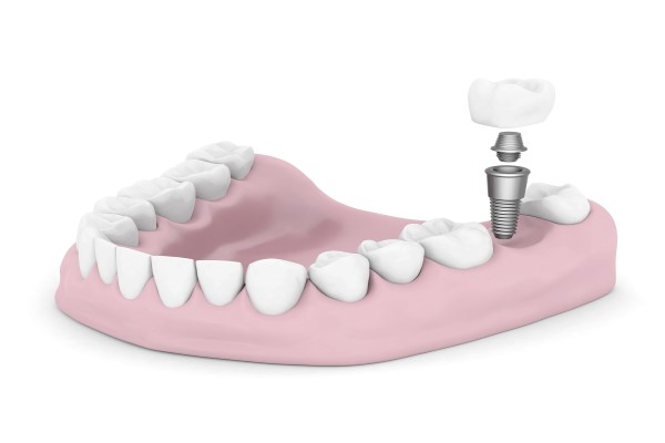 FAQs About Tooth Implants