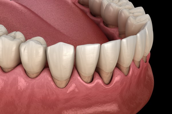 How Treating Gum Disease Can Improve Your Smile
