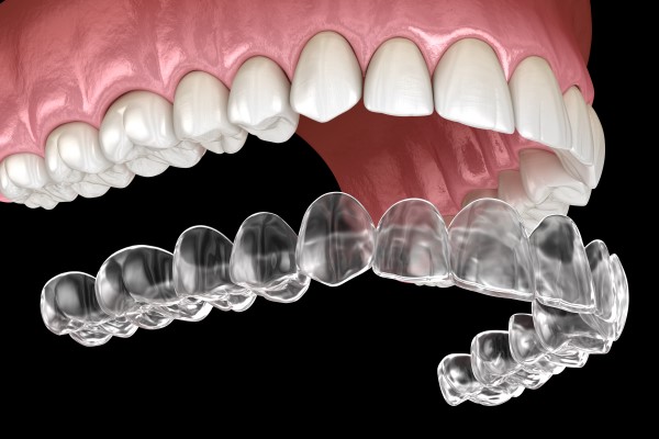 What Are Invisalign Clear Aligners Gladstone Family Dental And Implants Gladstone Missouri