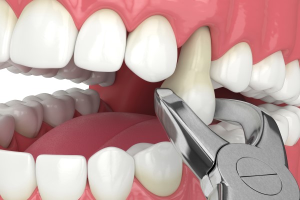 When Would A Dentist Recommend A Tooth Extraction?