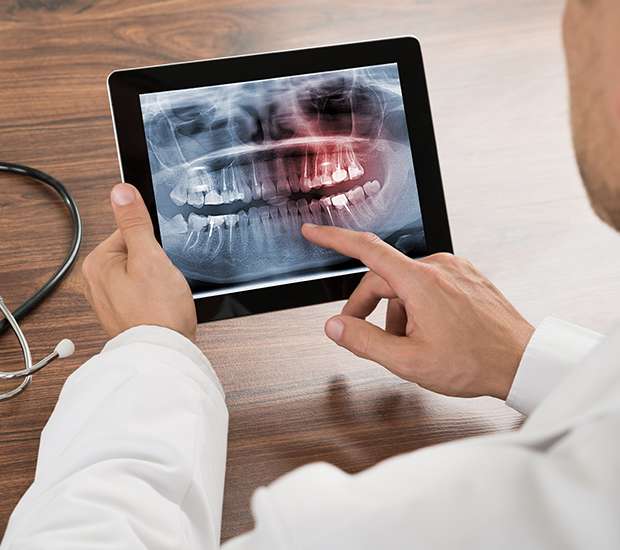 Gladstone Types of Dental Root Fractures