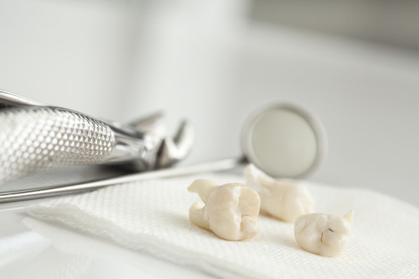 Common Myths And Facts About Wisdom Tooth Extraction